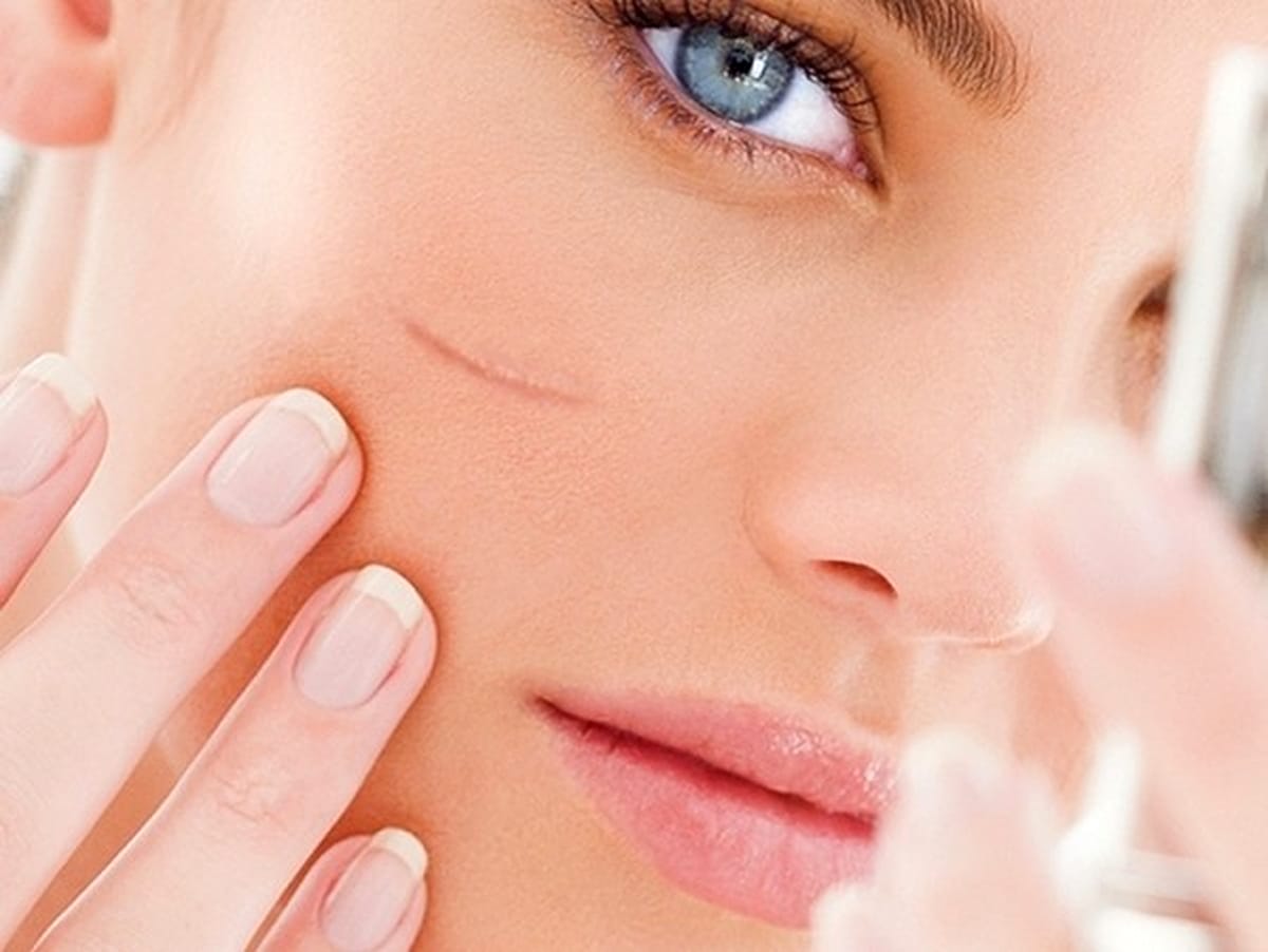 Cum să scapi de urmele de pe piele și de cicatrici cu ajutorul ingredientelor naturale