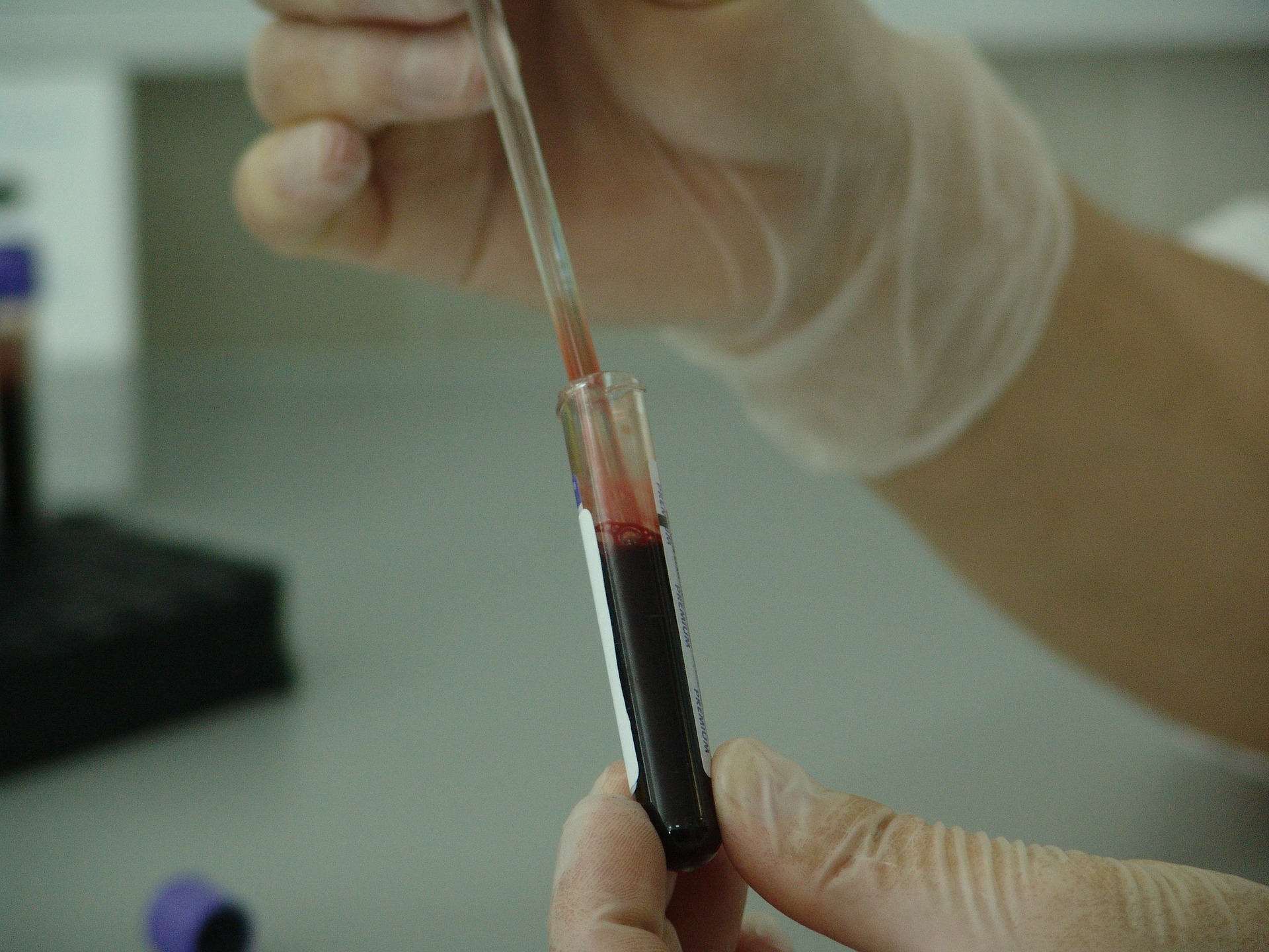 Un test sangvin personalizat prezice reacţia pacienţilor la medicamente înainte de administrare