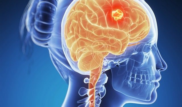 Tumorile pe creier – semnele care anunță cancerul cerebral