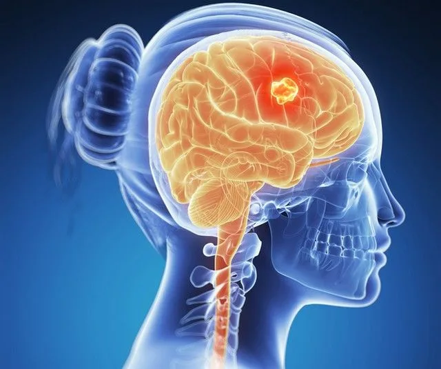 Tumorile pe creier – semnele care anunță cancerul cerebral