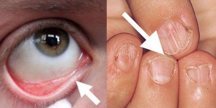 Carenţa de fier poate scădea imunitatea.