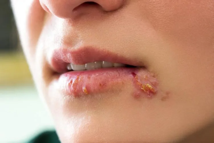 Ce trebuie să știi atunci când ai herpes