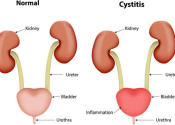 Infecțiile urinare netratate îți pot distruge rinichii.