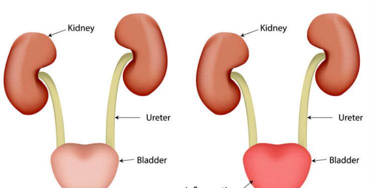Infecțiile urinare netratate îți pot distruge rinichii.