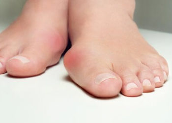 Ce sunt monturile și cum le putem preveni evoluția, înainte să ne afecteze picioarele