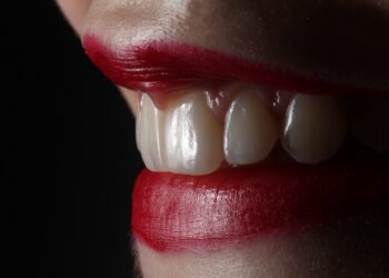 Ce să alegi între albirea dinților și fațetele dentare?