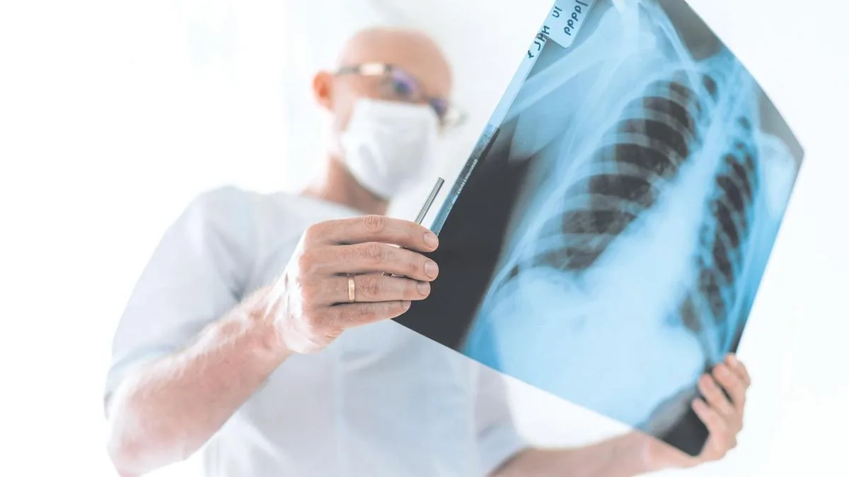 Screeningul cancerului pulmonar va fi o realitate în 14 comunități până la începutul anului 2023