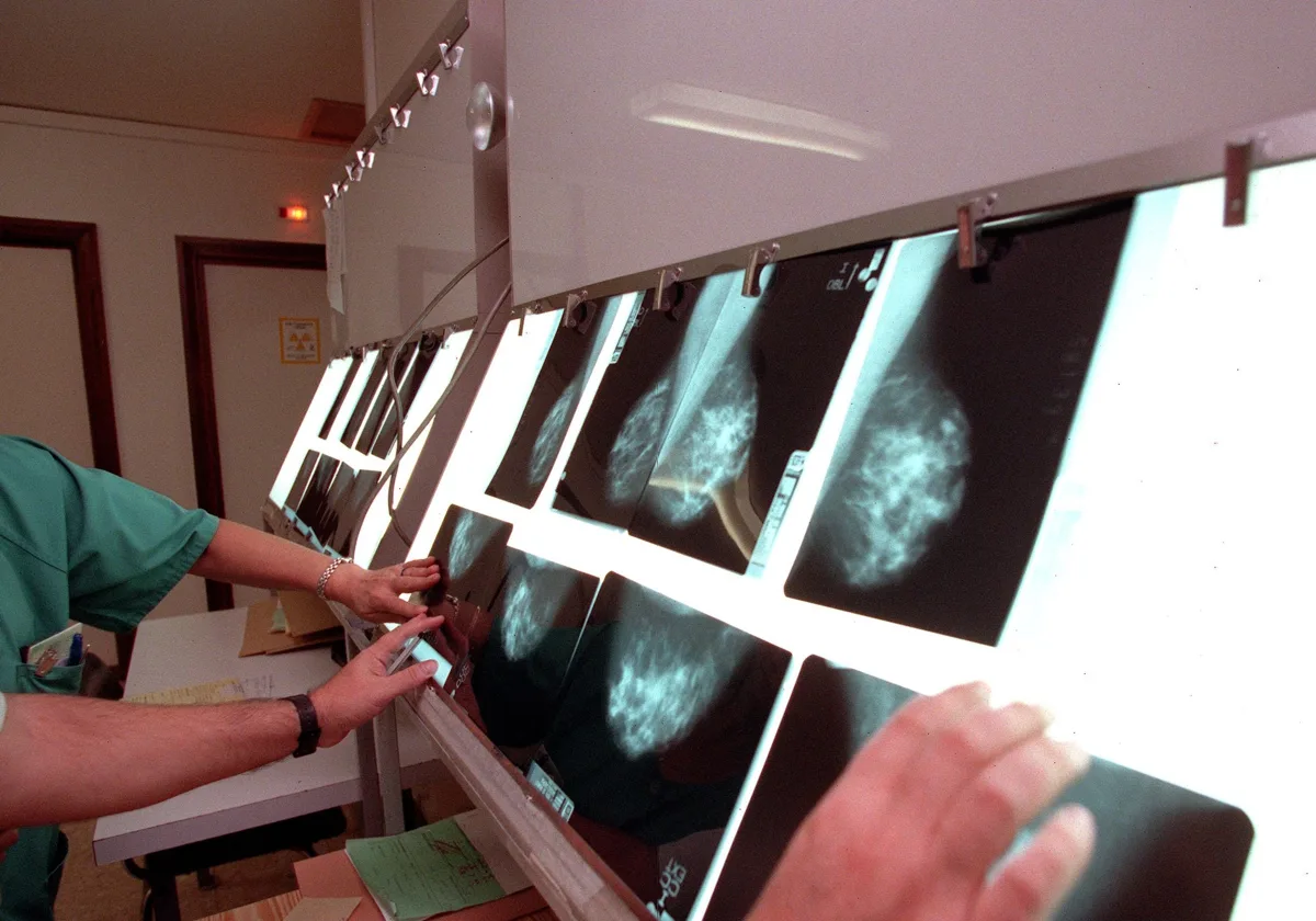 Cercetătorii spanioli creează un model pentru a prezice riscul individual de cancer de sân