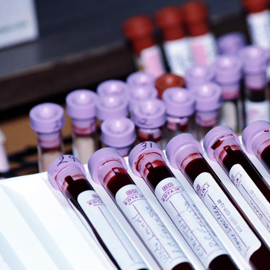 Modificări ale proteinelor din sânge constatate cu 2 ani înainte de diagnosticarea cancerului de sân