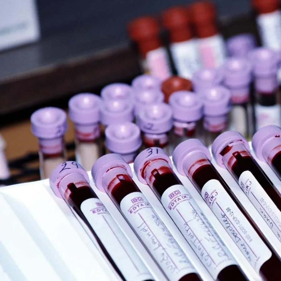 Modificări ale proteinelor din sânge constatate cu 2 ani înainte de diagnosticarea cancerului de sân
