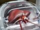 Noua procedură ar putea aduce încă 150 de transplanturi de ficat pe an în Marea Britanie